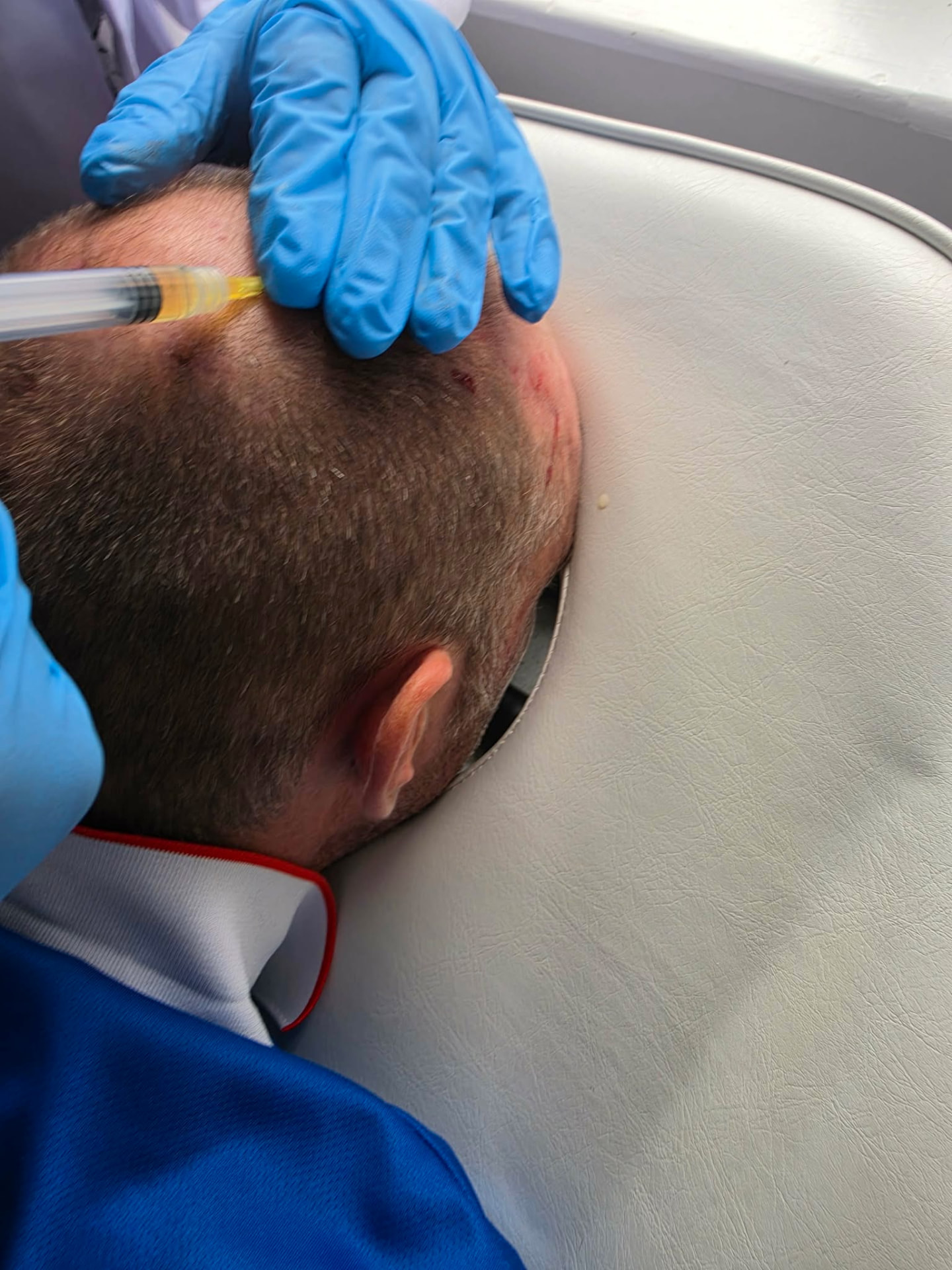 A practitioner carrying out a scalp treatment at Hair & Scalp Clinic Hereford